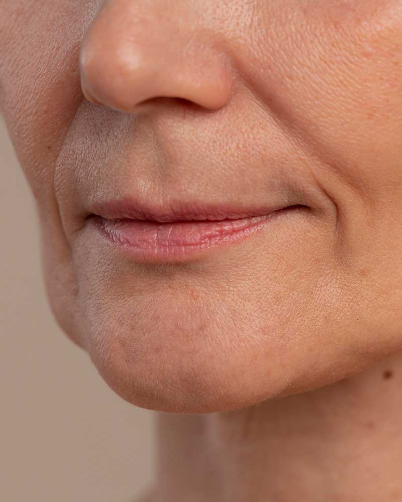 Chin Dimpling / Orange Peel Chin Treatment — Rayhana Esthetics Pittsburgh PA