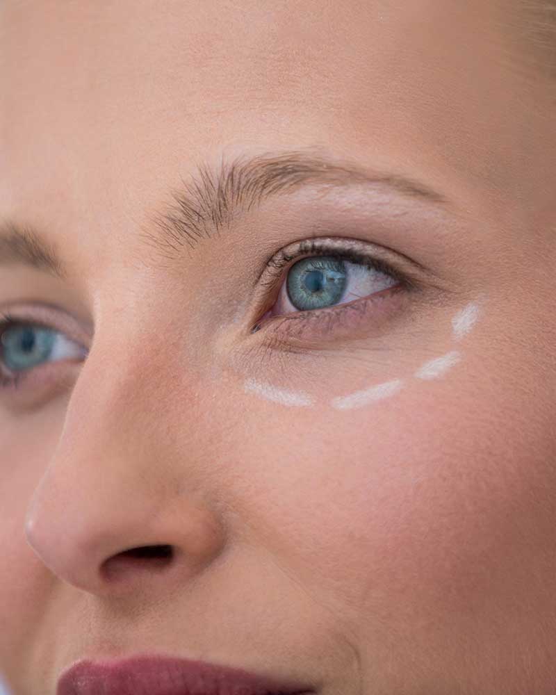 Crow's Feet Botox — Rayhana Esthetics Pittsburgh PA